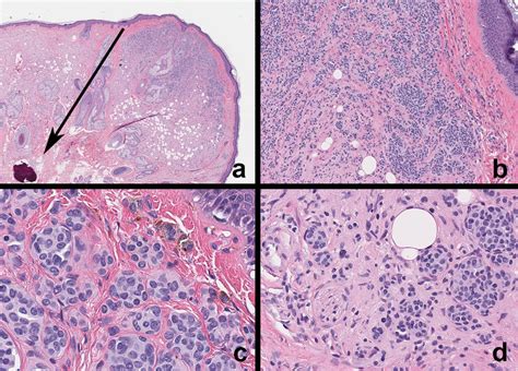 Epidermal Nevus Histology