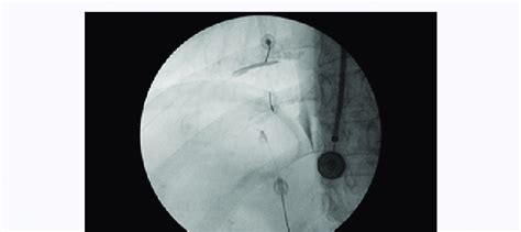 Intercostal Nerve Block Procedure