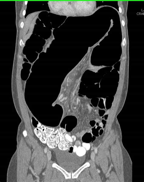 Sigmoid Volvulus - Colon Case Studies - CTisus CT Scanning