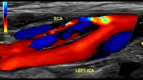 Carotid Artery: Youtube Carotid Artery