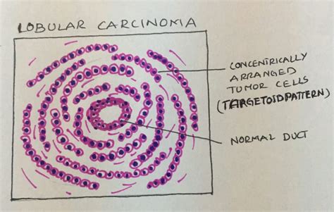 Invasive Lobular carcinoma. – Histopathology.guru