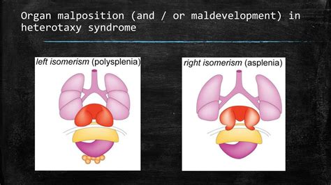 PPT - Congenital heart defects and heterotaxy syndrome PowerPoint Presentation - ID:2282637