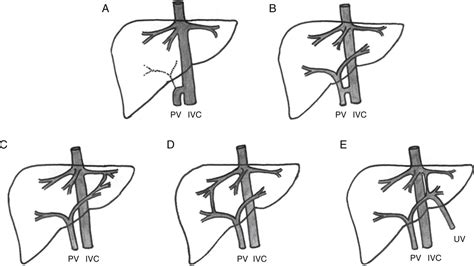 Congenital Portosystemic Shunt: Characterization of a Multis ...