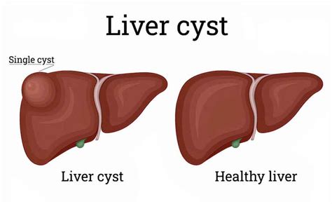 Liver Cyst (Hepatic Cyst) > Should I Worry If I Have a Liver Cyst?