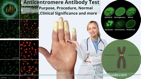 Anticentromere Antibody Test Test Purpose, Procedure, Normal values ,Clinical Significance and more