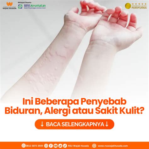 Ini Beberapa Penyebab Biduran, Alergi atau Sakit Kulit? | RSU Wajak Husada