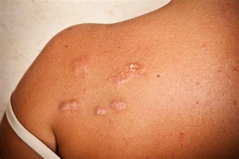 Keloid Scars: Risks, Causes, Prevention, and Treatment