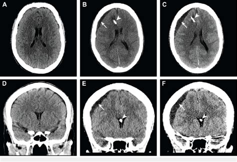 Head computed tomography images before and after Ommaya reservoir ...