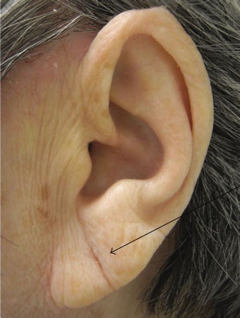 Diagonal Earlobe Crease Predicts Heart Disease