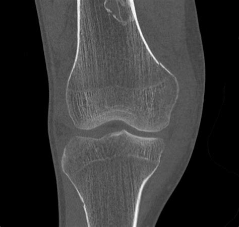 Medial Condyle Fracture Ulnar Nerve