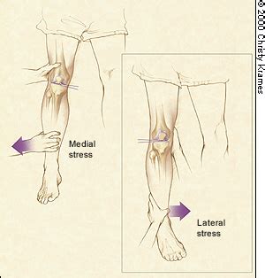 Acute Knee Effusions: A Systematic Approach to Diagnosis | AAFP