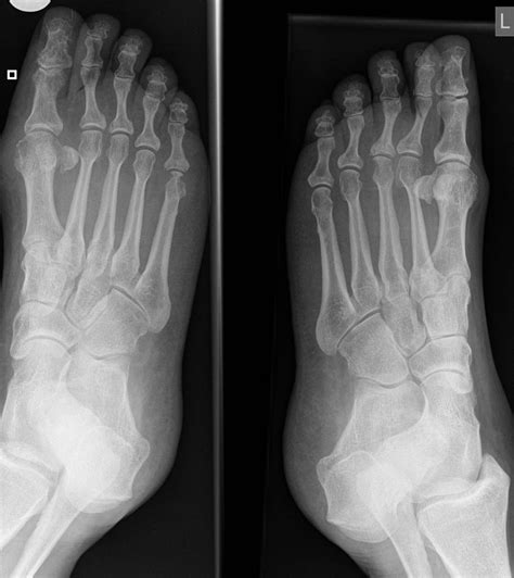 Rheumatoid arthritis x ray - wikidoc