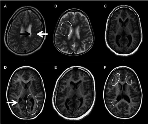 Abnormal Brain Mri Mri Scan Images Brain Scan Mri Mri Scan | Images and ...