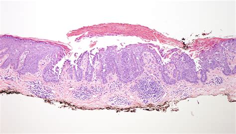 Acantholytic Acanthoma | Dermatopathology