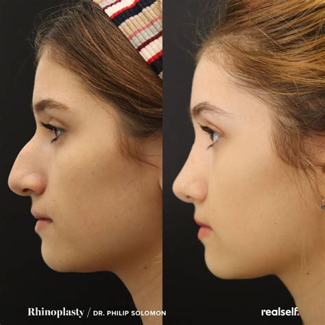 #plastic surgery rinoplastia Rhinoplasty Before and After in 2020 | Rhinoplasty nose jobs ...