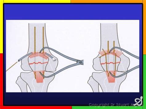 Tension Band Wiring