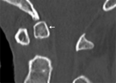 25 Os Odontoideum | Radiology Key