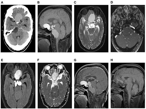 Frontiers | Craniopharyngioma involving the anterior, middle, and posterior cranial fossa in ...