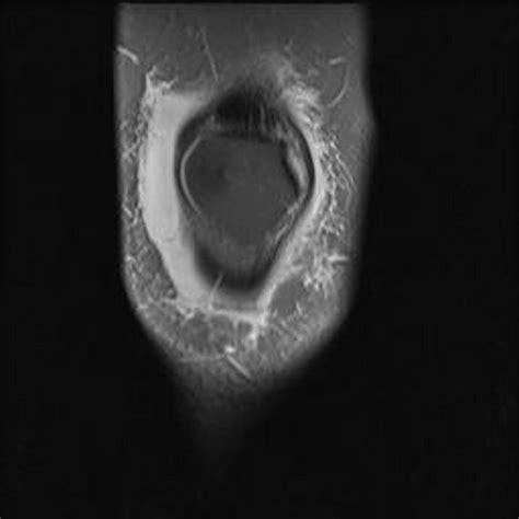 Bursitis MRI - wikidoc