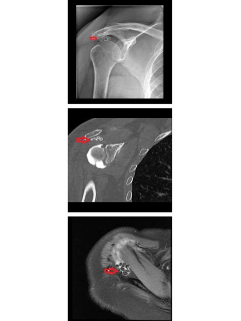 Synovial Osteochondromatosis of Shoulder | International Journal of ...