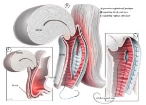 Figure 3-Posterior Vaginal Wall Repair-Website - Your Pelvic Floor