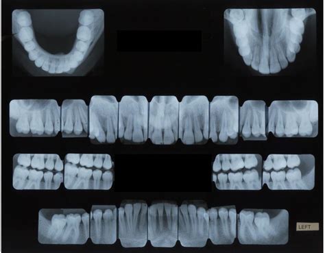 FMX: Full Mouth X-Rays — Brockton Dental X-Ray Lab