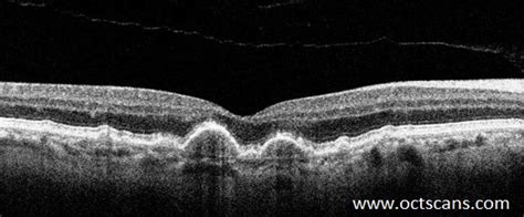 Age-Related Macular Degeneration - Optical Coherence Tomography Scans