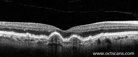 Age-Related Macular Degeneration - Optical Coherence Tomography Scans