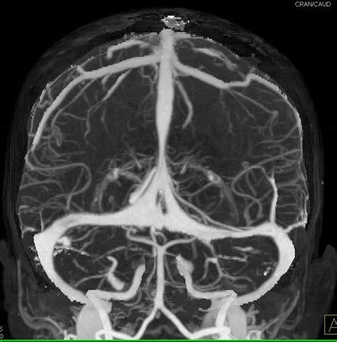 CT Venogram with Dual Energy Bone Removal - Neuro Case Studies - CTisus CT Scanning