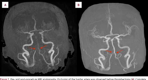 Vertebral Artery Occlusion Treatment