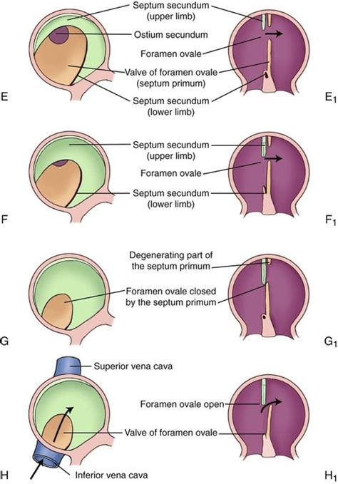 Atrial Septal Defects | Radiology Key