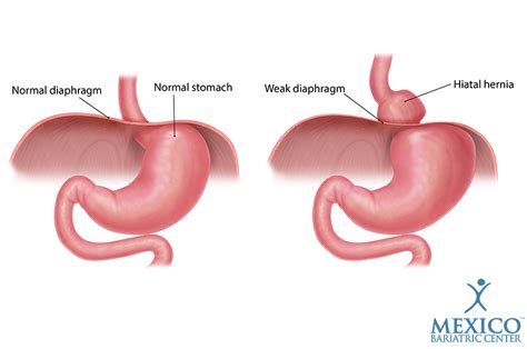 Hiatal Hernia Repair, GERD, and Acid Reflux - Mexico Bariatric Center