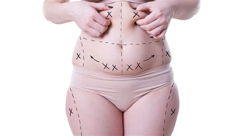 Extended Tummy Tuck | Abdominoplasty Procedure | Cosmetic Town