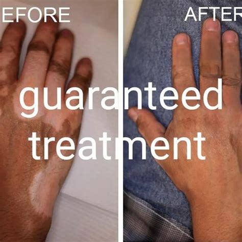 Guarantee Treatment Vitiligo at Rs 10 in Kishangarh Renwal | ID: 22687042848