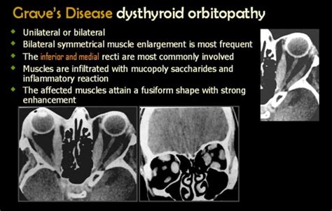 Thyroid associated orbitopathy (TAO) - Not all muscles are invovled - usually bilateral and ...