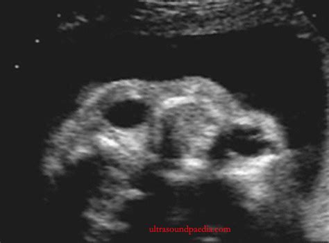 Hypertelorism – ULTRASOUNDPAEDIA