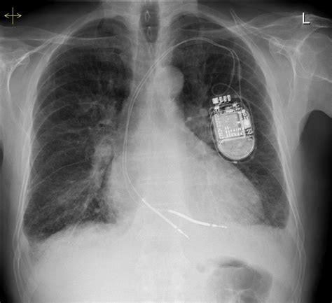 Kerley B Lines Cxr : Septal lines in lung | Radiology Reference Article ...