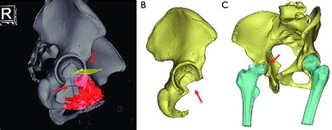 The surgical planning of partial acetabular tumor resection and... | Download Scientific Diagram