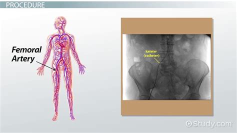 Angiogram | Definition, Complications & Types - Lesson | Study.com