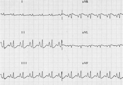 Right Atrial Enlargement • LITFL Medical Blog • ECG Library Basics