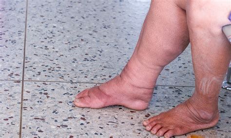 Lymphedema: Living with swelling and stiffness | NIH MedlinePlus Magazine