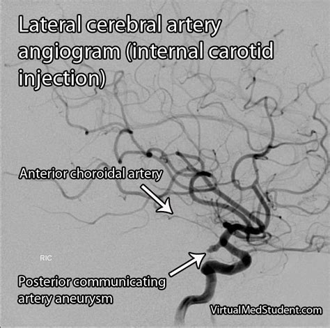 VirtualMedStudent.com || Anterior Choroidal Artery