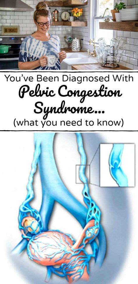 11 Pelvic congestion syndrome ideas in 2021 | pelvic congestion ...