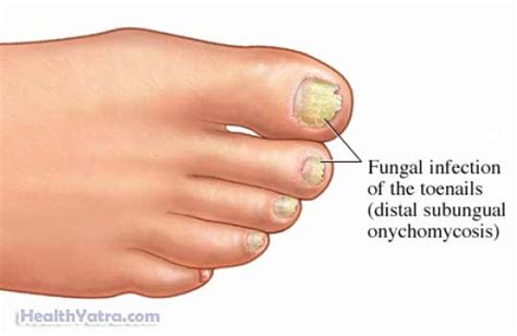 Onychomycosis Definition, Causes, Symptoms and Treatment Cost in India