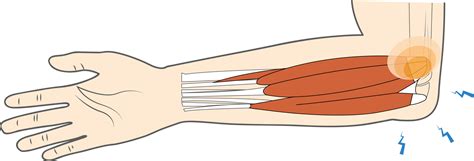 Medial Epicondyle Of Humerus Pain