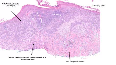 Dermpath Made Simple - Neoplastic: Basal Cell Carcinoma