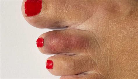 Broken toe: Treatments, symptoms, pictures, and healing time