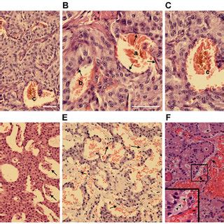 Pancreatic neuroendocrine tumors are characterized by endothelial cell... | Download Scientific ...