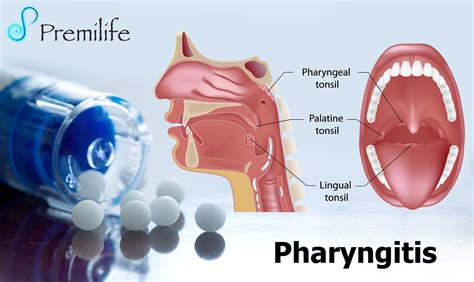 Pharyngitis | Premilife - Homeopathic Remedies