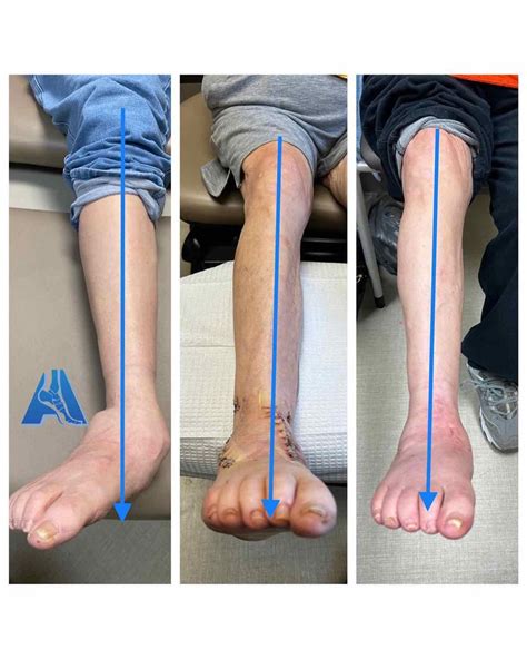 Failed Triple Arthrodesis/Flat Foot Surgery Repaired with Ankle Fusion and Revision of Triple ...